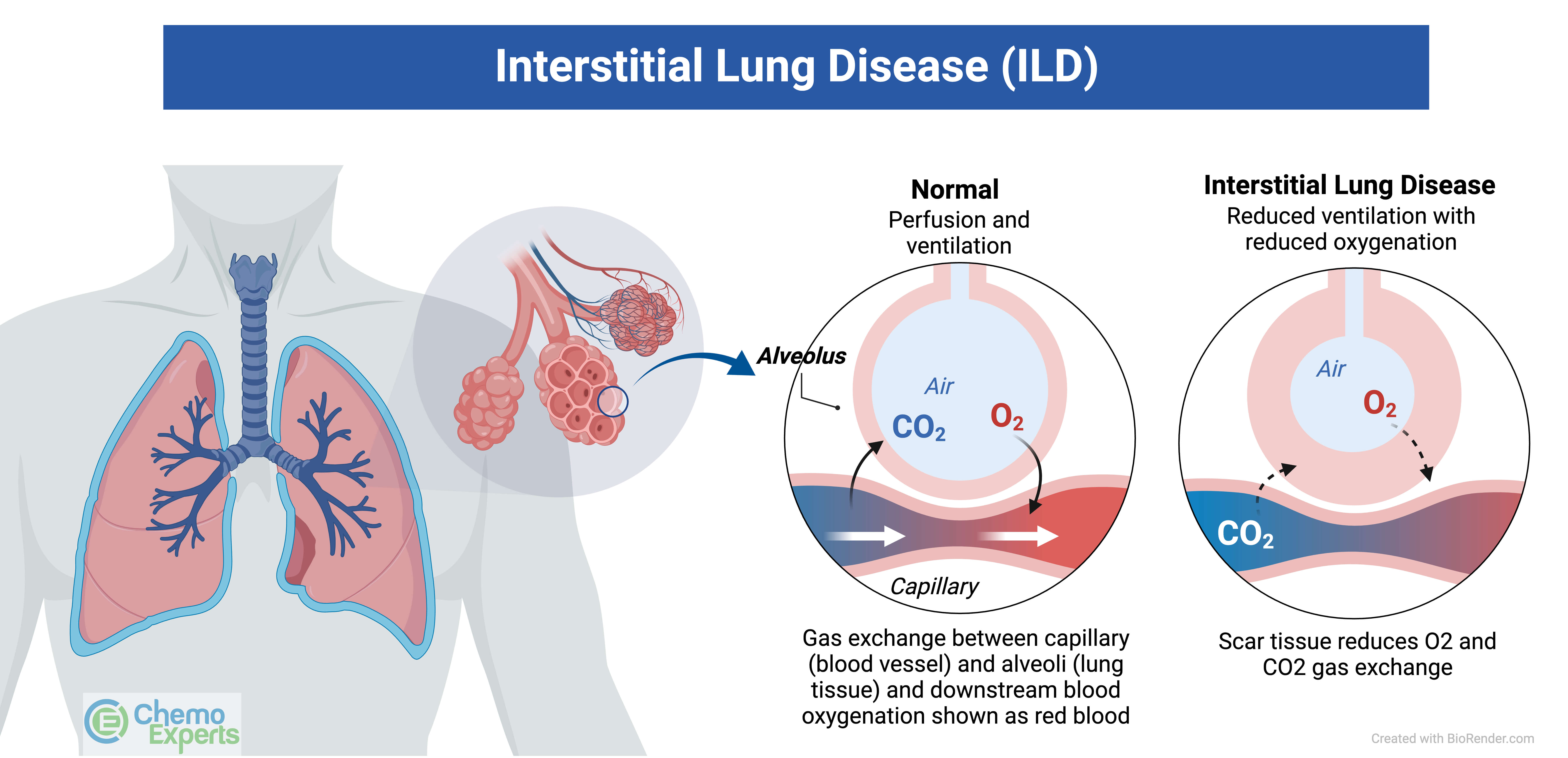 Interstitial Lung Disease ChemoExperts